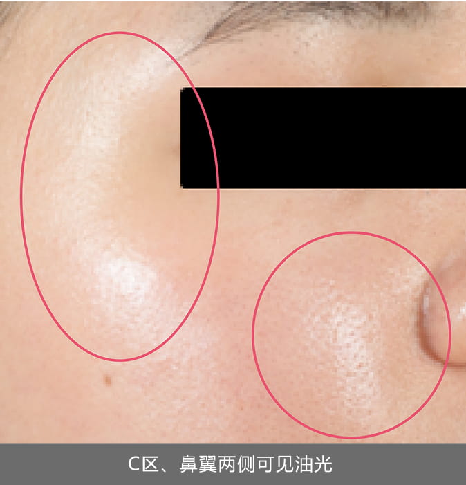 C区、鼻翼两侧可见油光